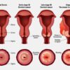 Understanding Cervical Cancer