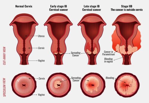 Understanding Cervical Cancer