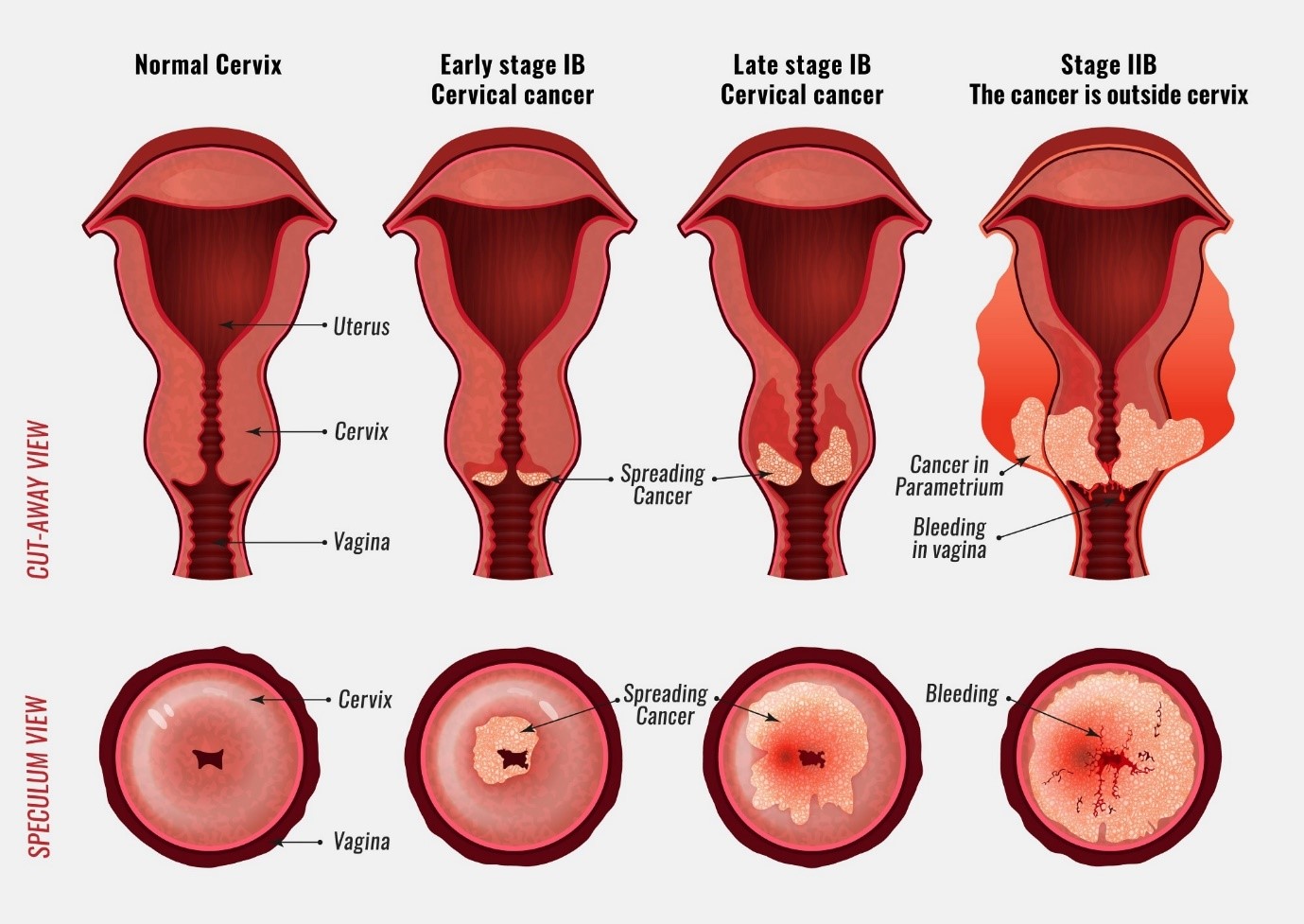 Understanding Cervical Cancer